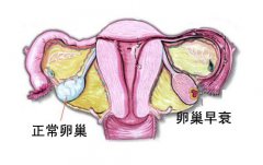 卵巢早衰会让更年期提前